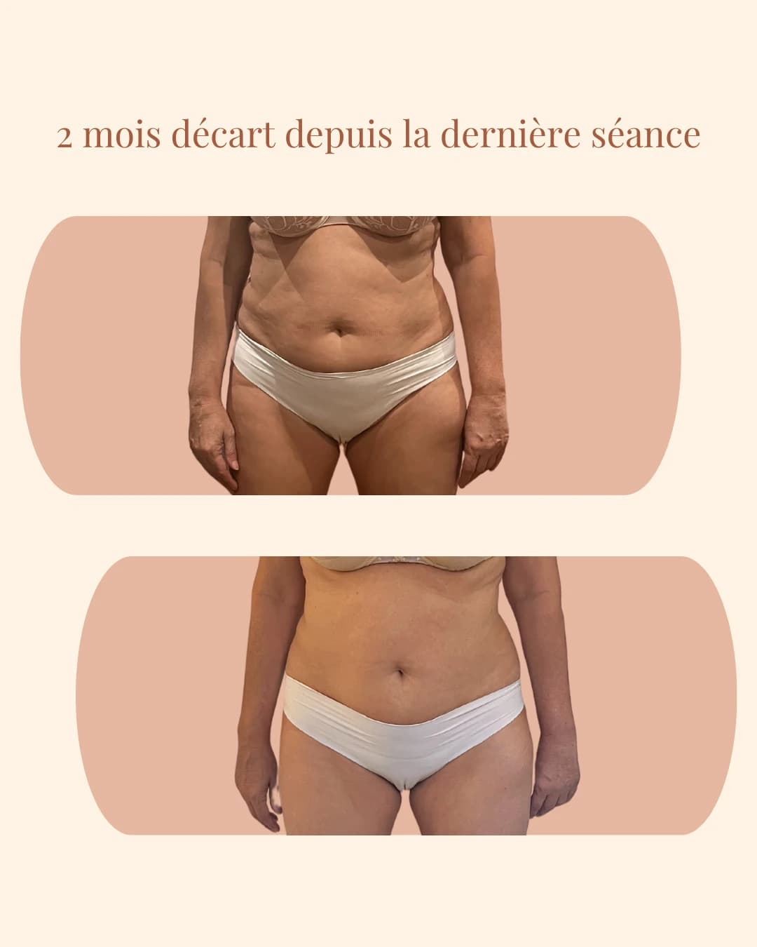 Image patiente 2 mois après la fin de la cure GAD®