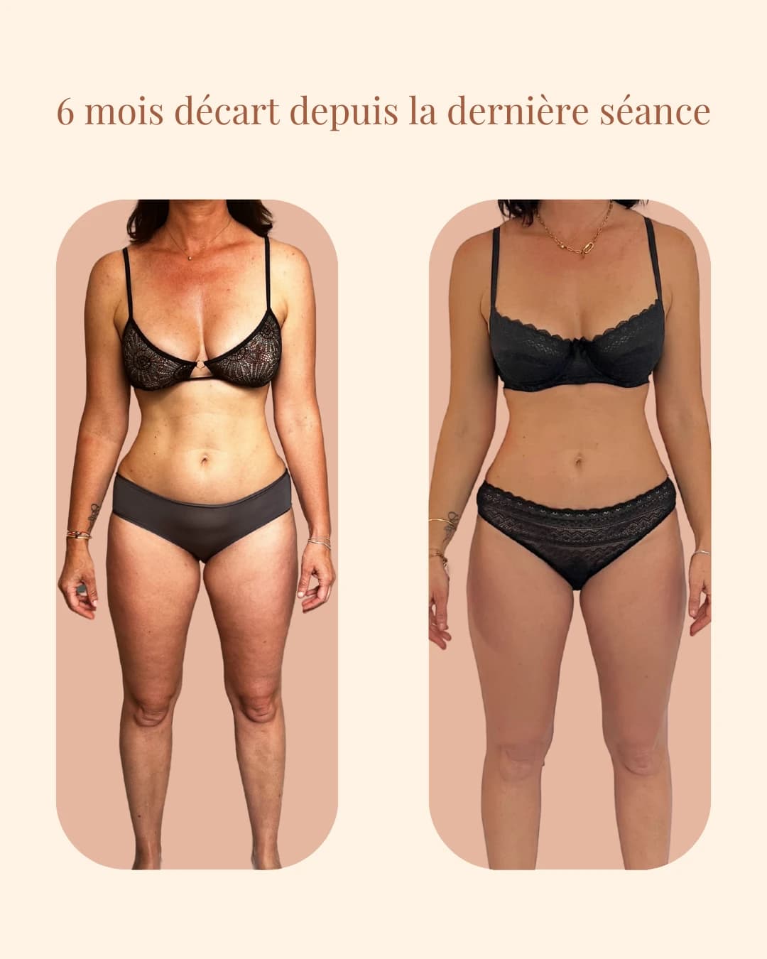 Image patiente 6 mois après la fin de la cure GAD®